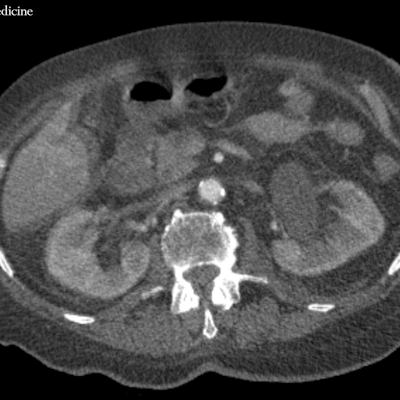 80-year-old woman with abdominal pain and tachycardia