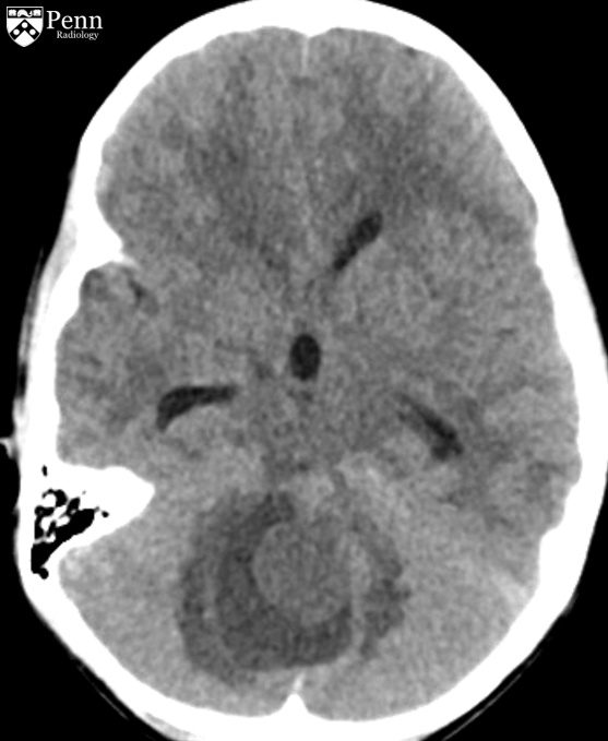 5-year-old girl with headache, gait abnormality