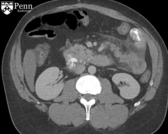 52-year-old man with abdominal pain