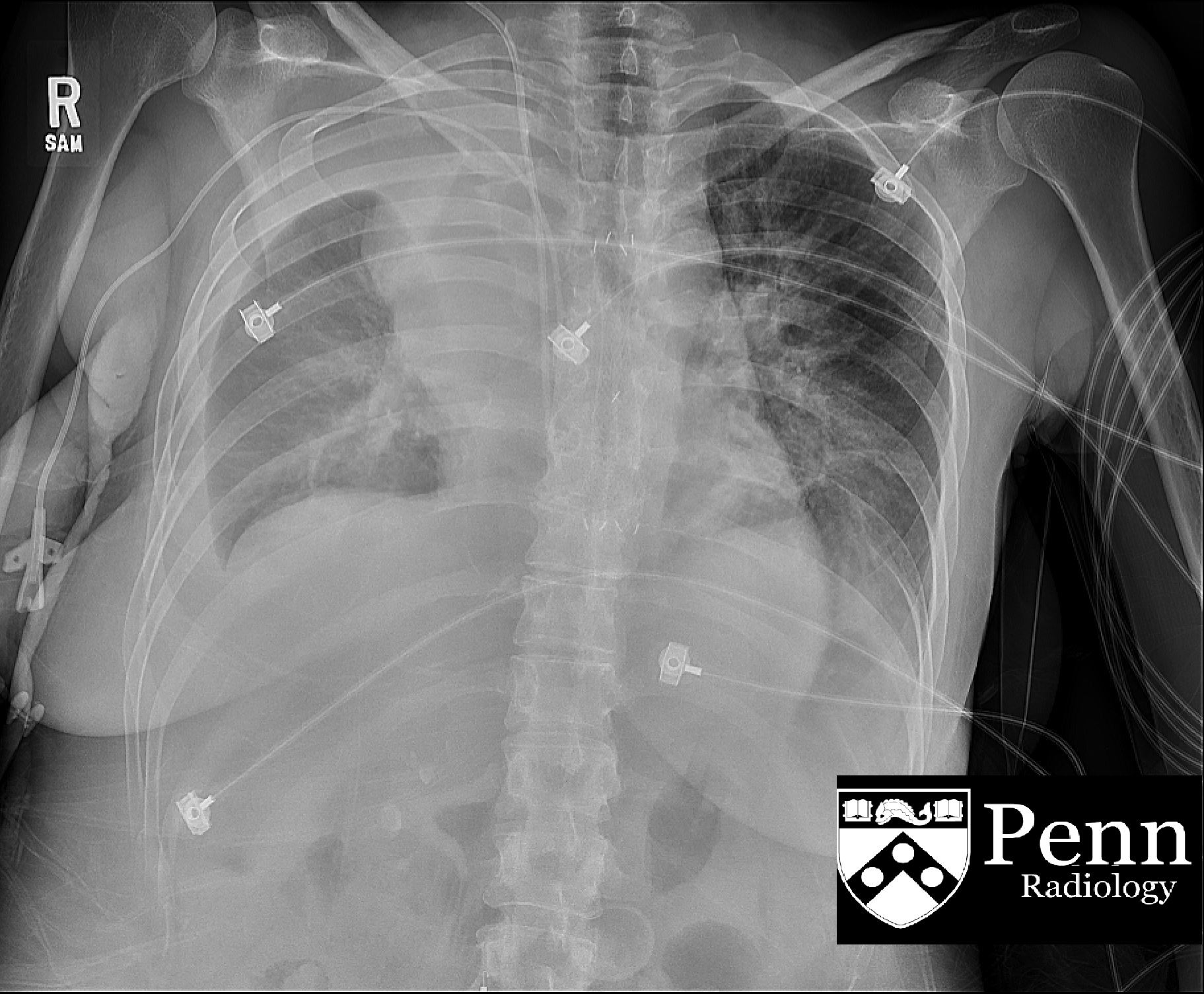 38-year-old woman postoperative with shortness of breath