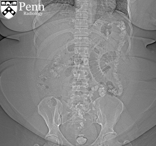 45-year-old woman with abdominal pain