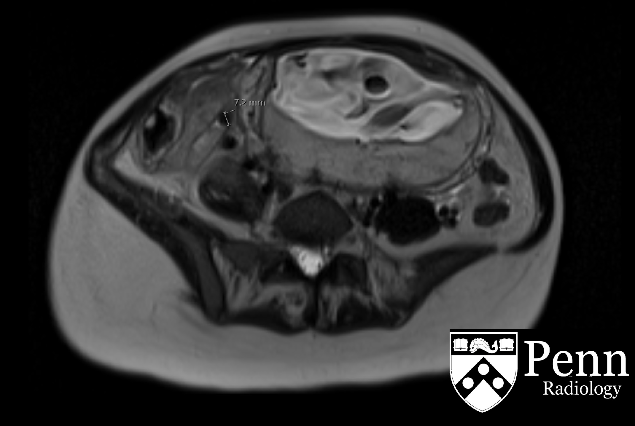 18-year-old woman with severe abdominal pain