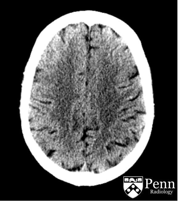80-year-old man with altered mental status, seizure