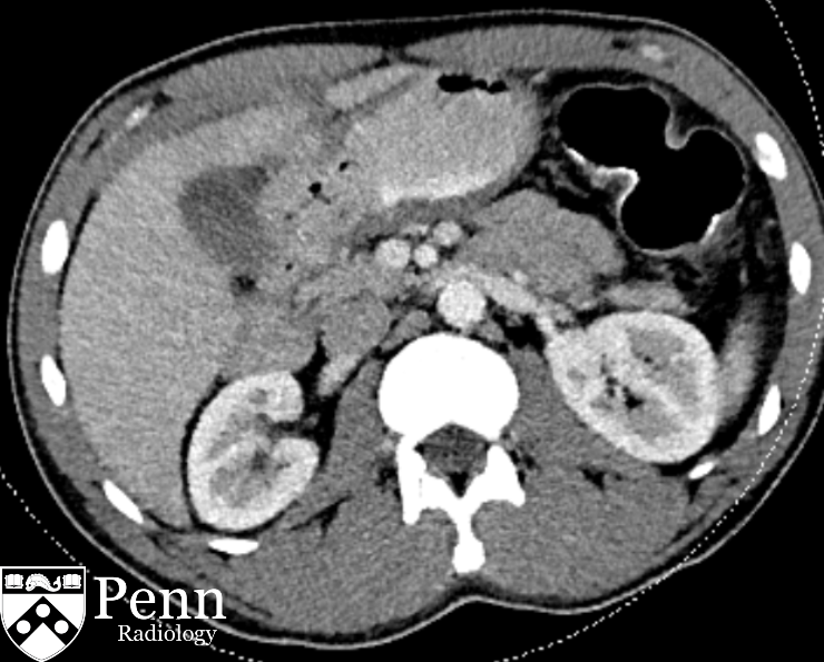 39-year-old man with chronic abdominal pain