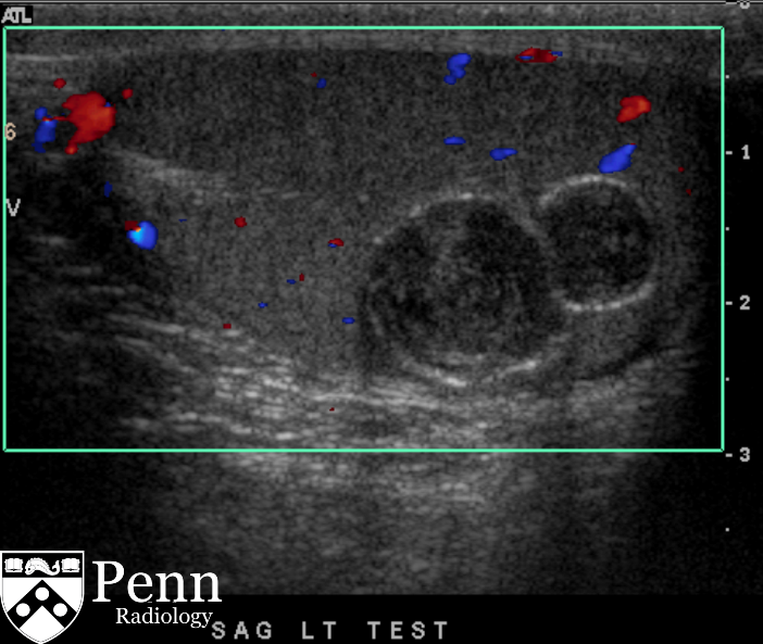 20-year-old man with testicular mass