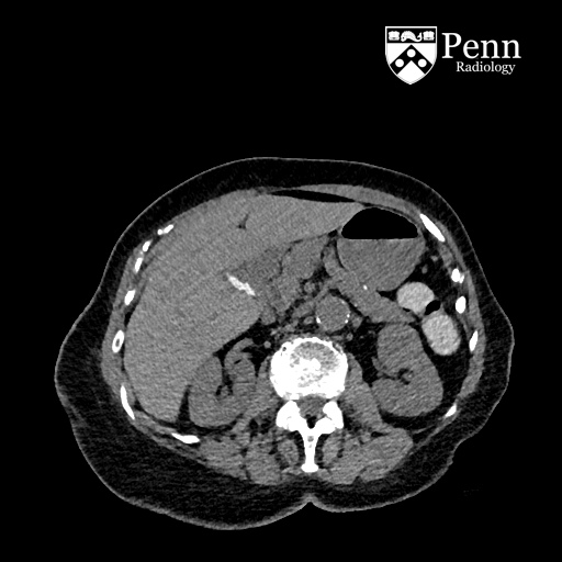 83-year-old female former smoker with imaging follow-up