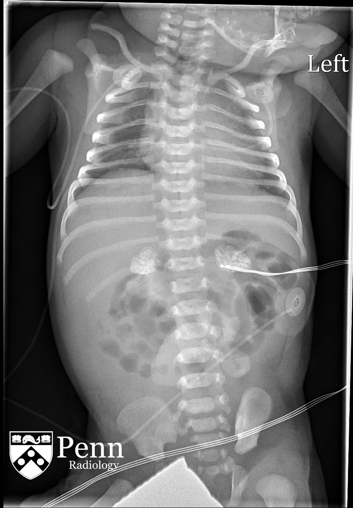0-day-old neonate with failure to thrive