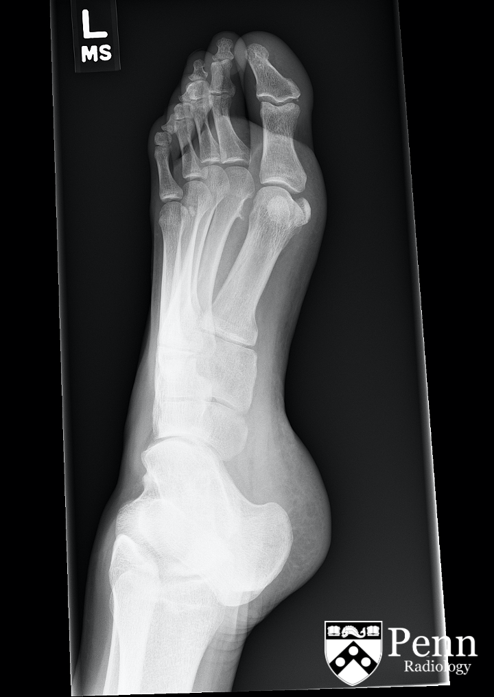 26-year-old man with foot pain