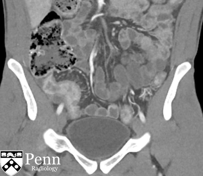 22-year-old man with abdominal pain, diarrhea