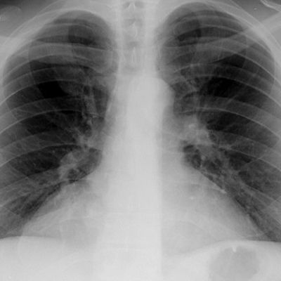 48-year-old man with worsening chest pain