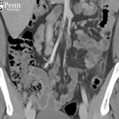 19-year-old man with lower abdominal pain