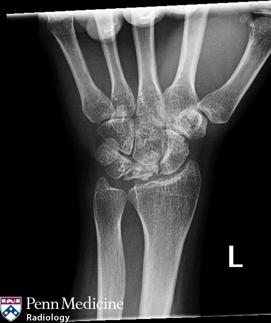 31-year-old woman with left hand pain