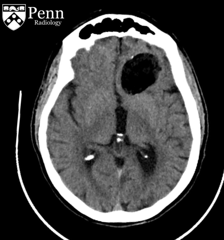 62-year-old man with head trauma