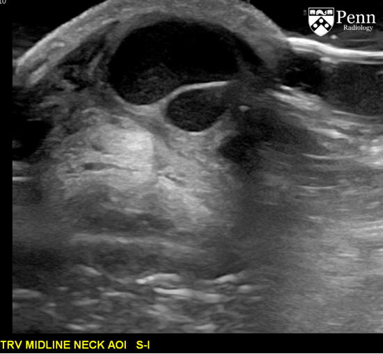 17-year-old boy with neck mass, low-grade fever