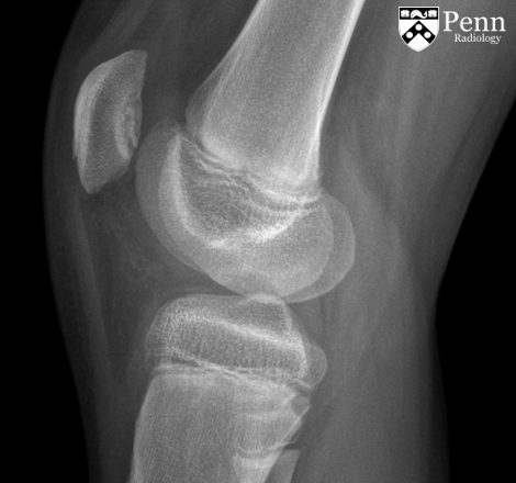 11-year-old boy with knee pain