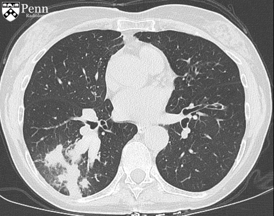 67-year-old woman with cough, recurrent pneumonia