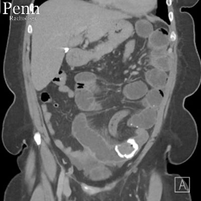 54-year-old woman with abdominal pain