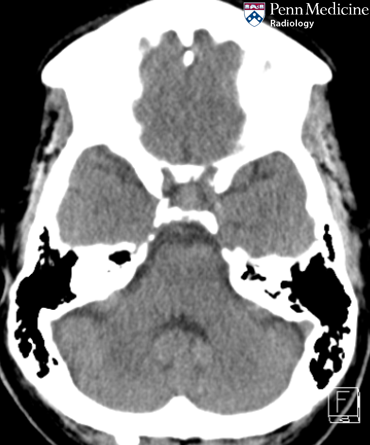53-year-old woman with headache