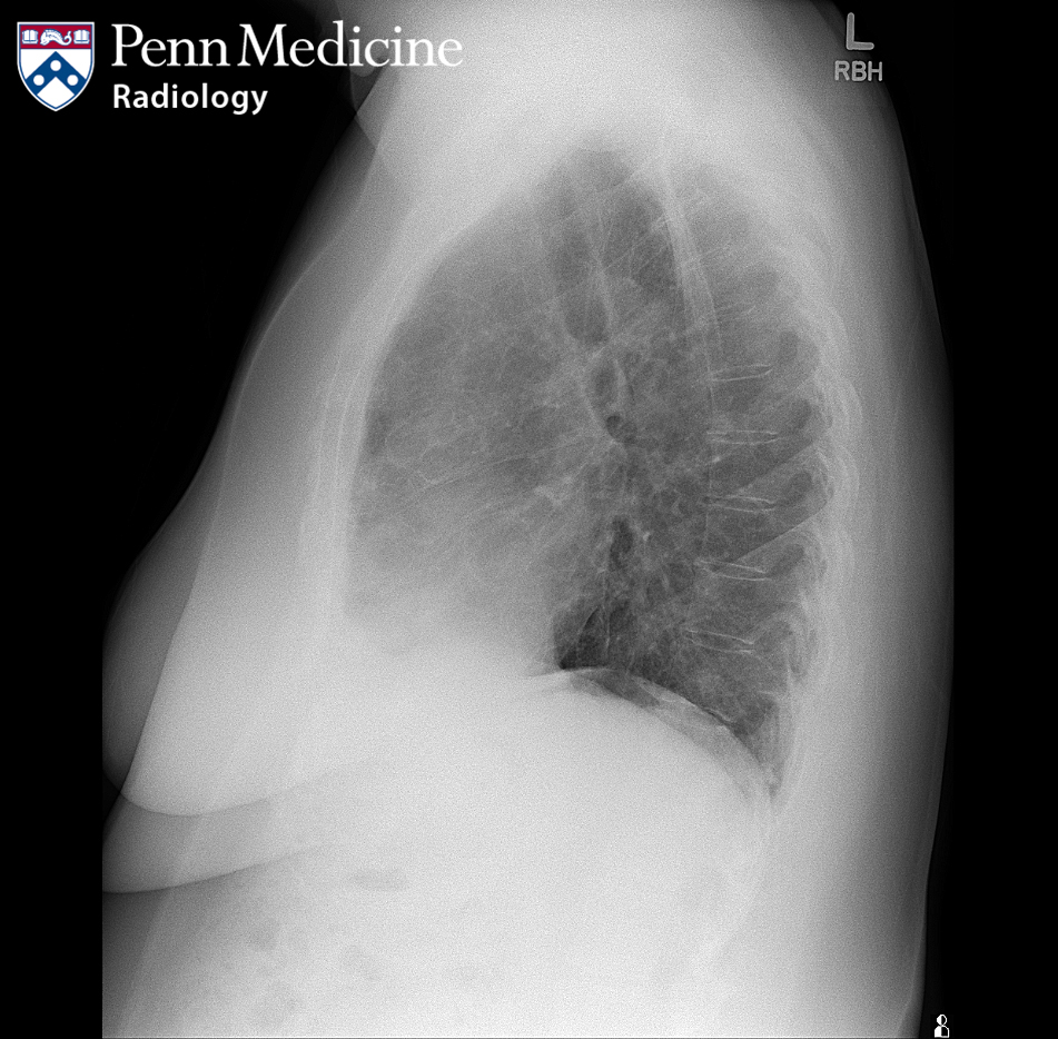 61-year-old woman with cough