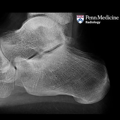 19-year-old man with foot pain