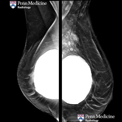 54-year-old woman undergoing routine mammography screening