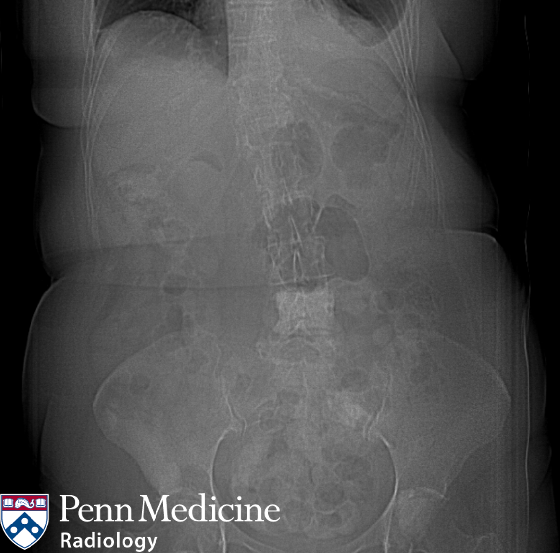 65-year-old woman with abdominal pain