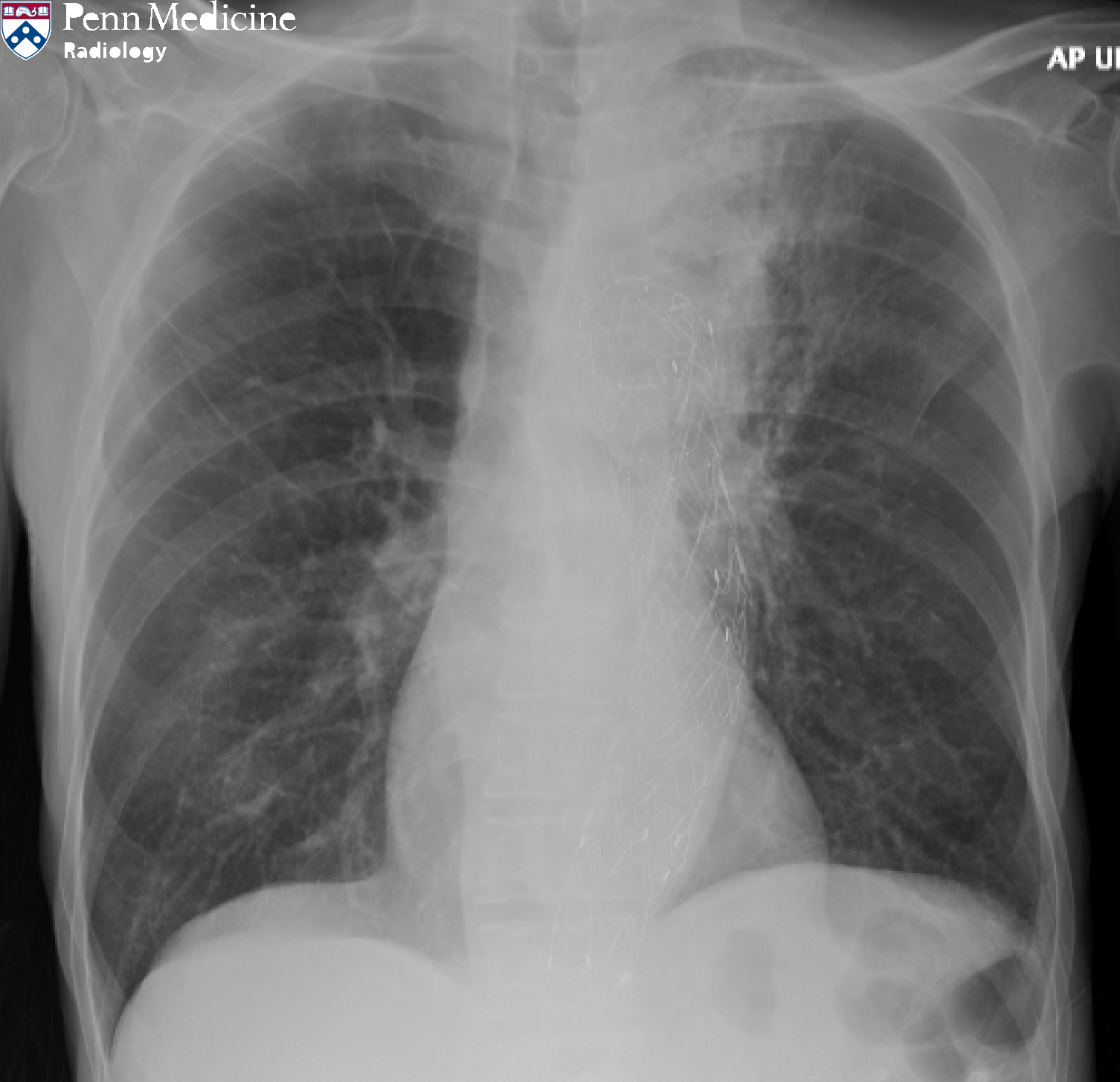60-year-old man with cough, recurrent falls