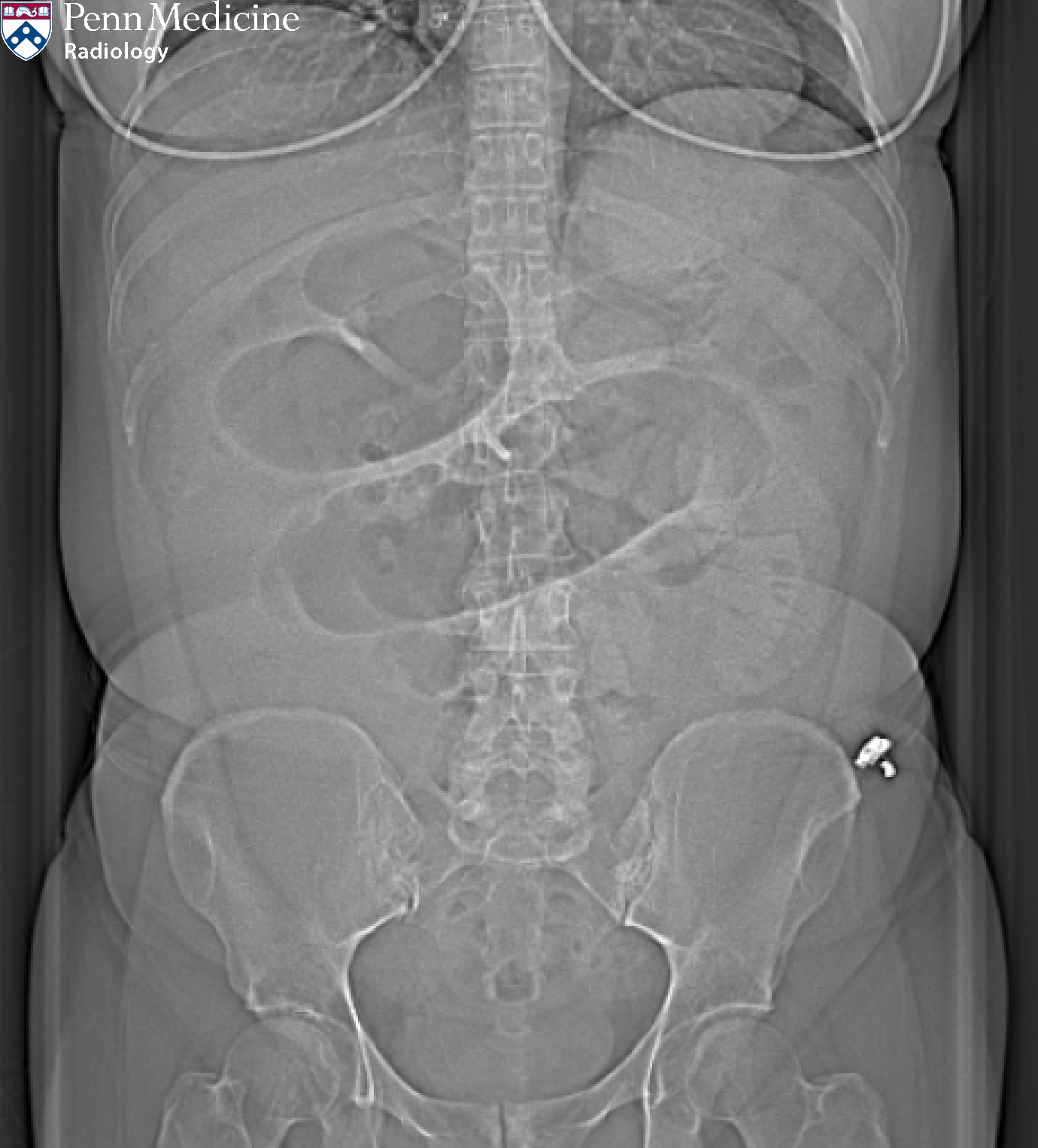 46-year-old woman with abdominal pain