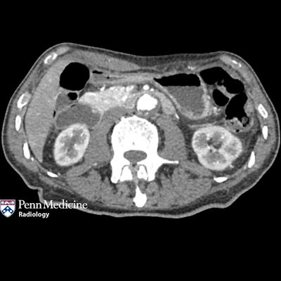 65-year-old man with abdominal pain, early satiety