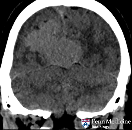 57-year-old man with frequent headaches
