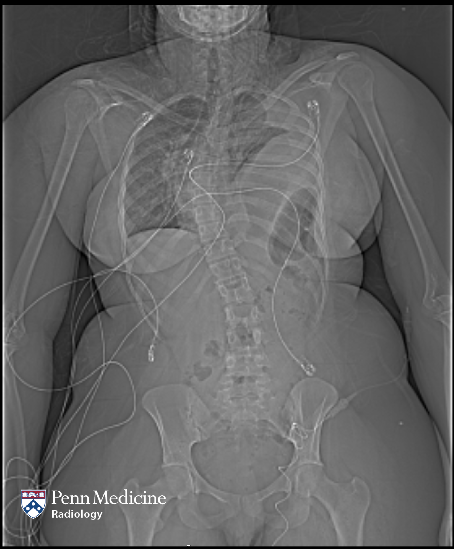 20-year-old woman with shortness of breath after traffic accident