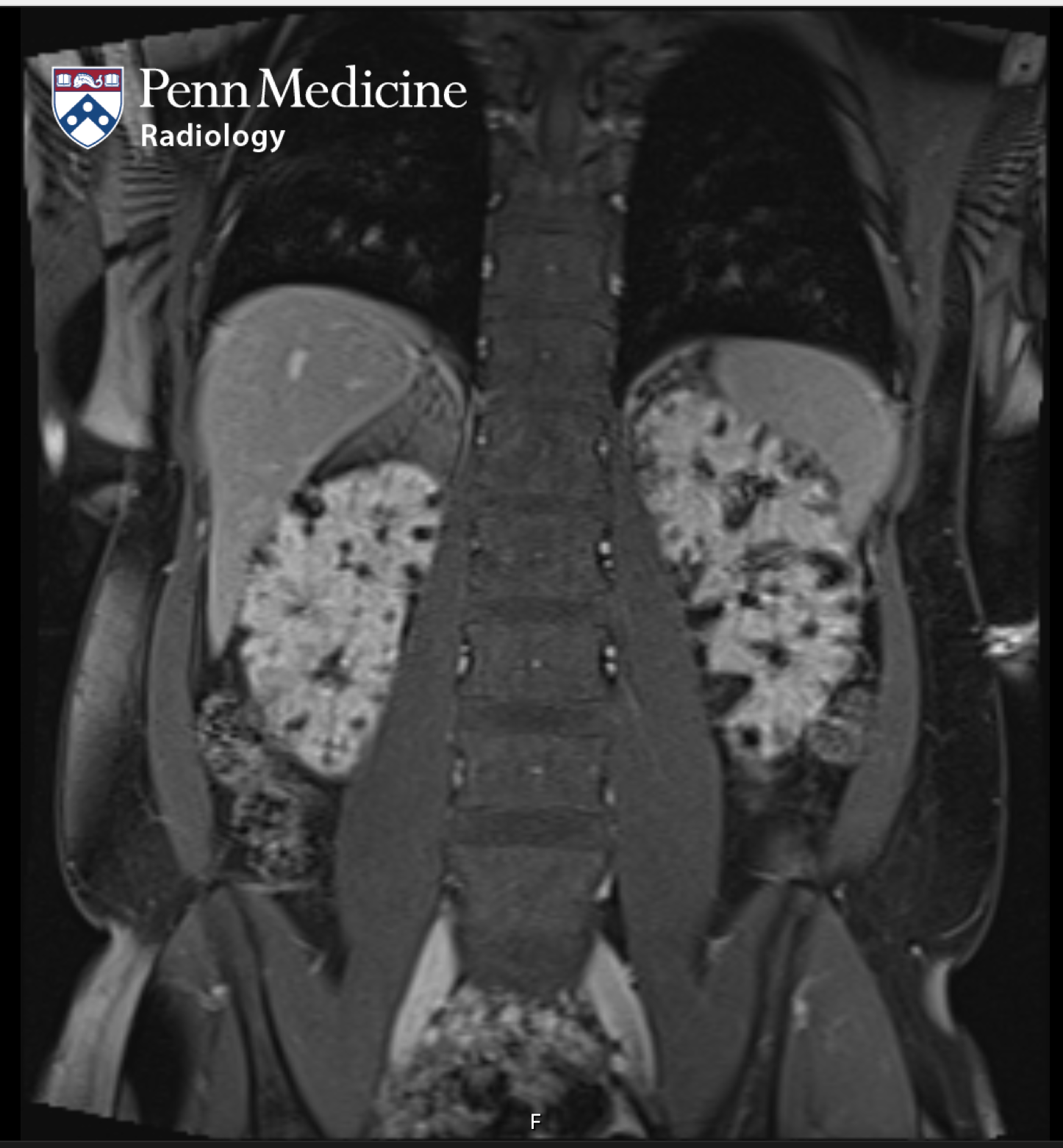 30-year-old woman with enlarging renal lesions
