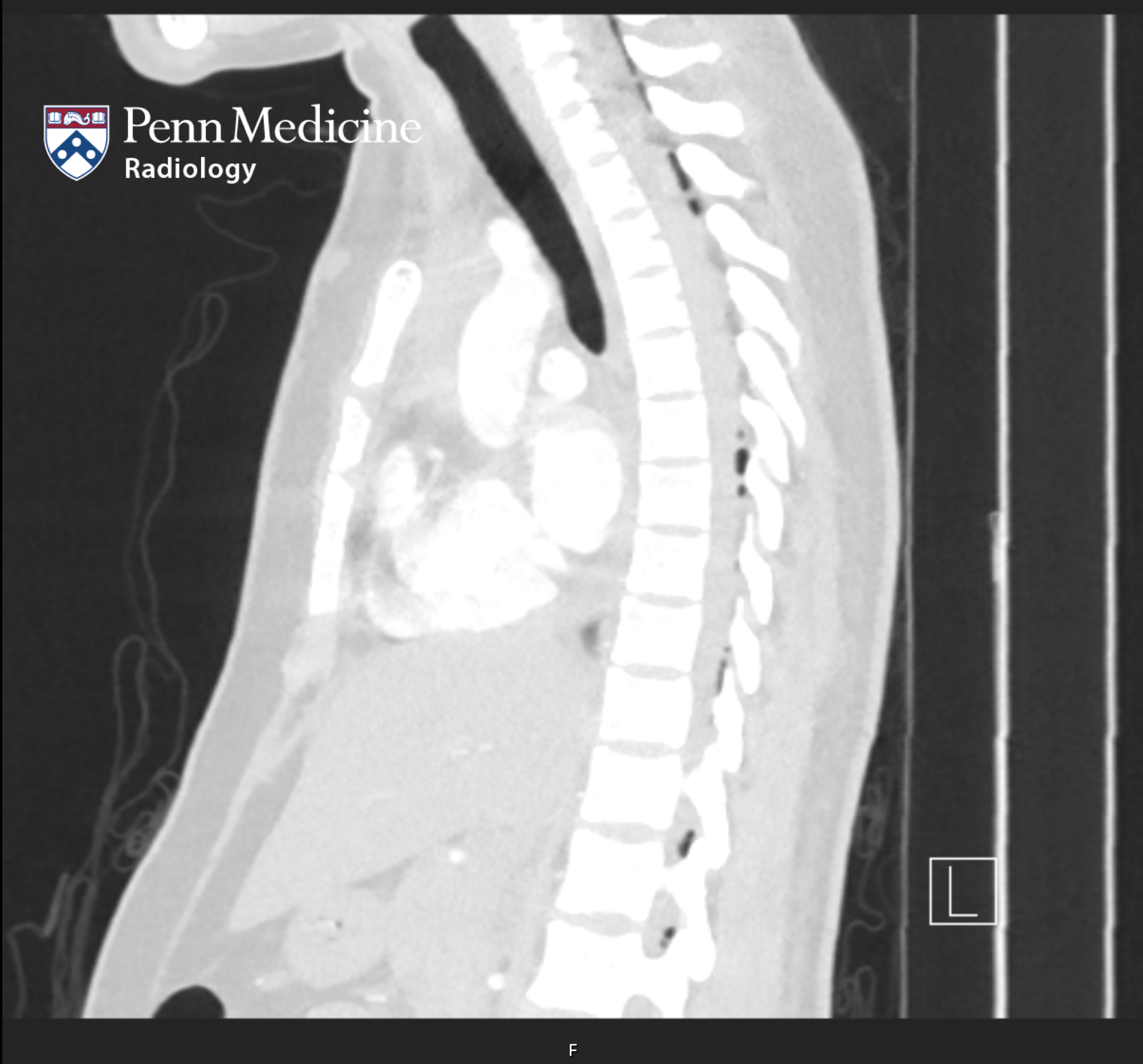 20-year-old postpartum woman with chest, back pain