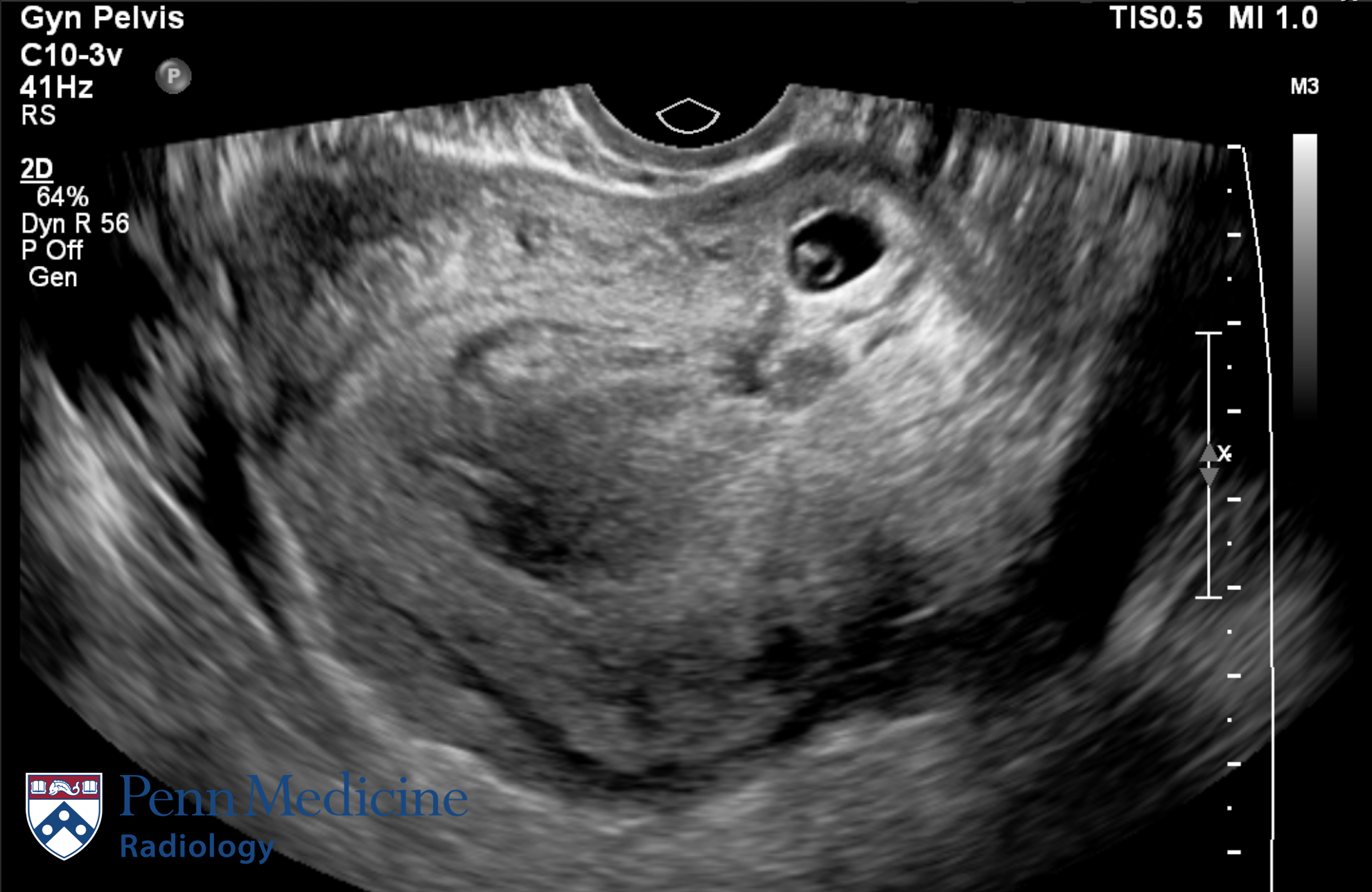 33-year-old woman with vaginal bleeding, cramping