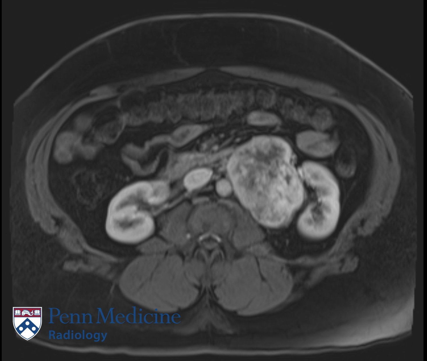 38-year-old woman with hypertension, abdominal distension