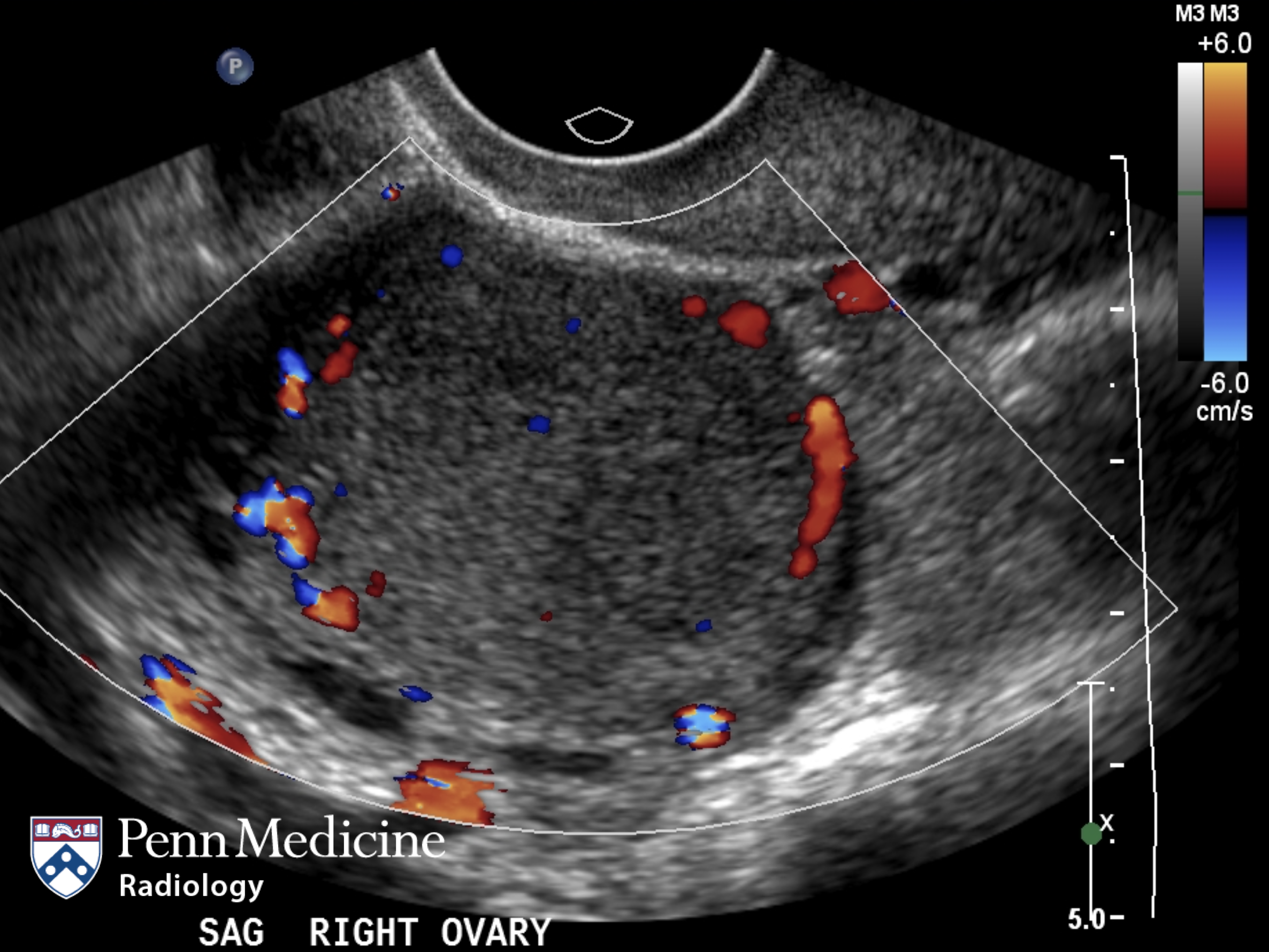 21-year-old woman with irregular menses, hirsutism