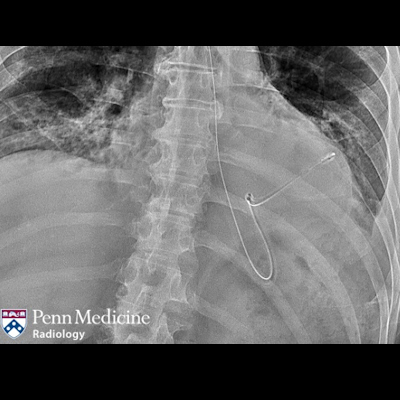 75-year-old man with abdominal pain, vomiting