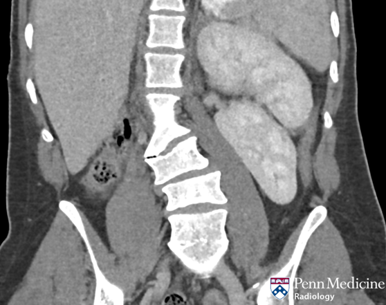 28-year-old woman with abdominal pain