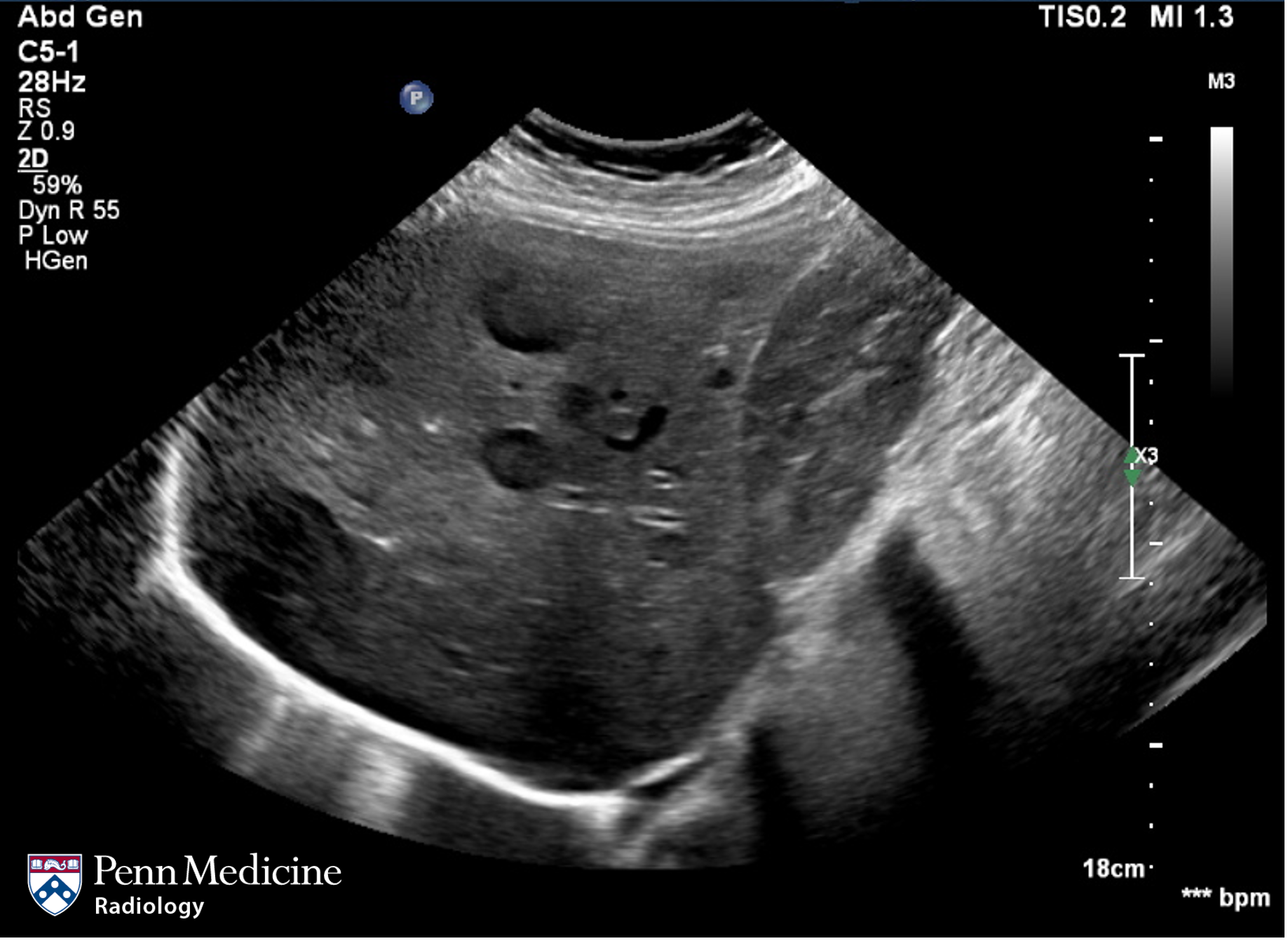 39-year-old woman with right upper quadrant pain