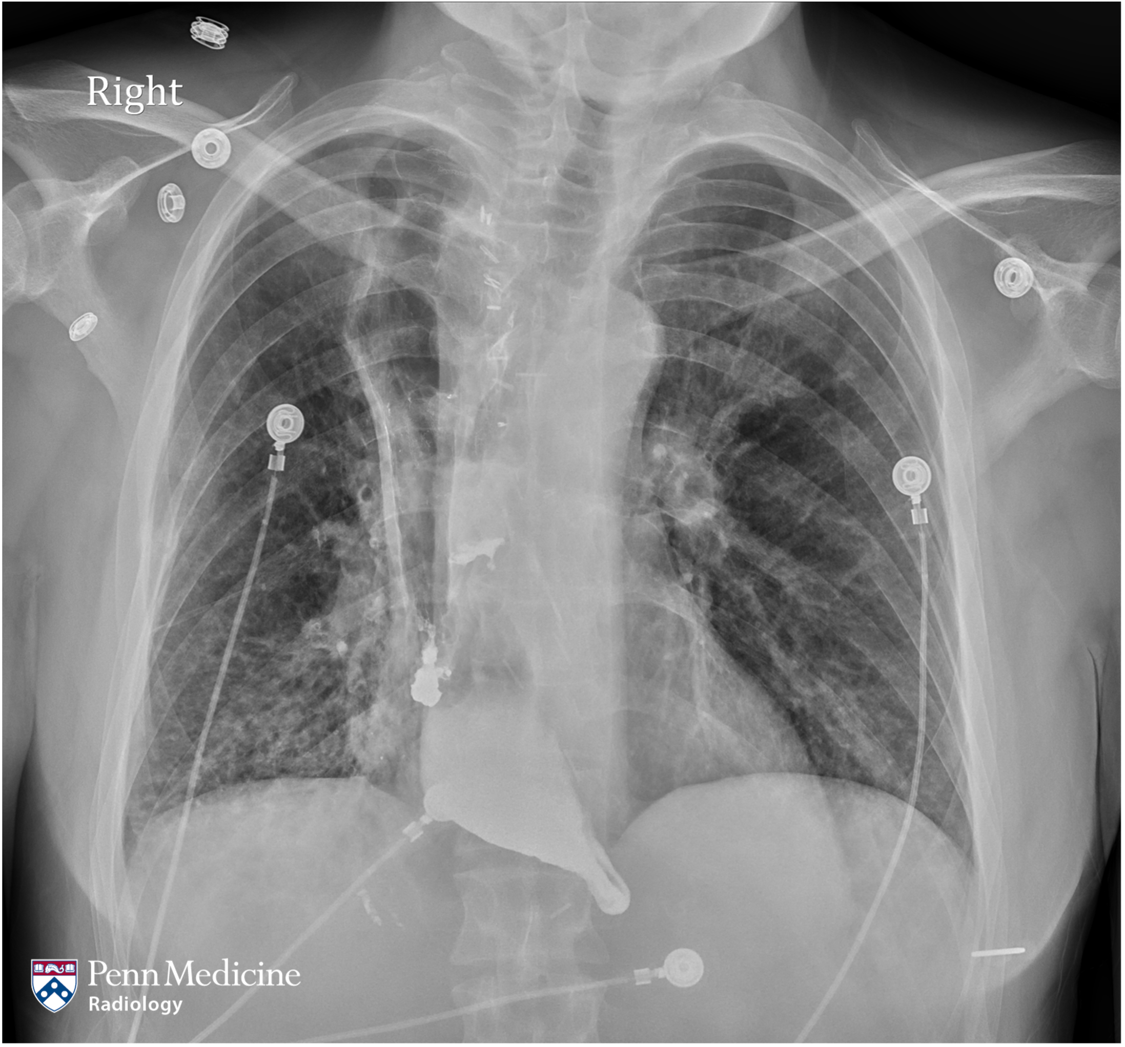 41-year-old man with dysphagia, cough, fever