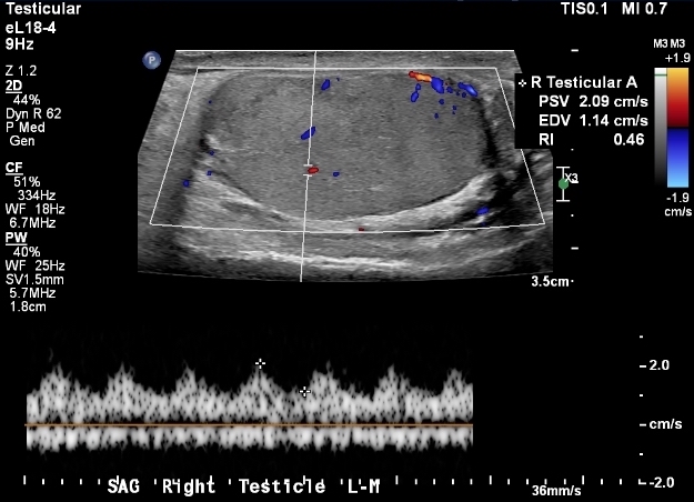 64-year-old man with right testicular pain