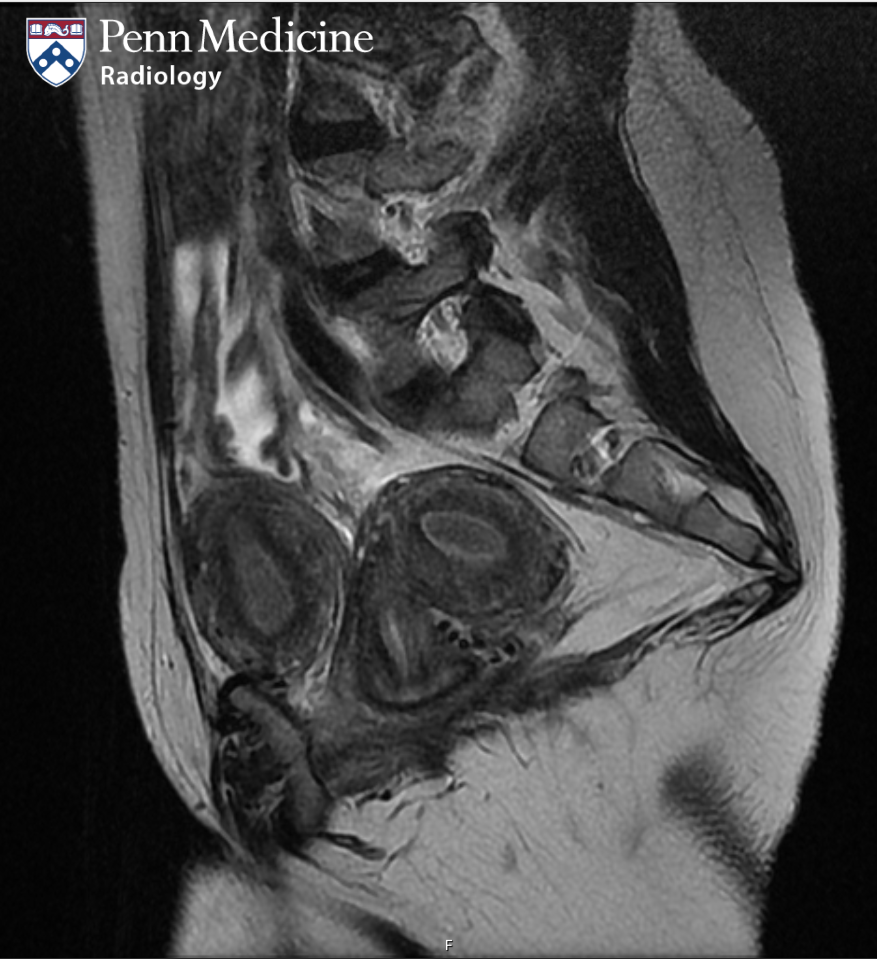 20-year-old woman with pelvic pain