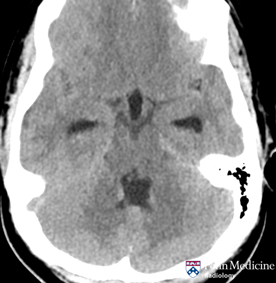 22-year-old woman with fever, headache, vomiting