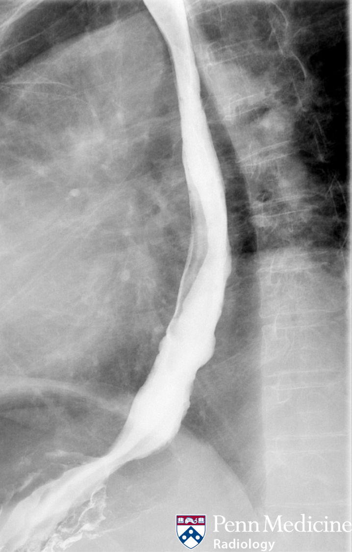 67-year-old woman with dysphagia, acid reflux