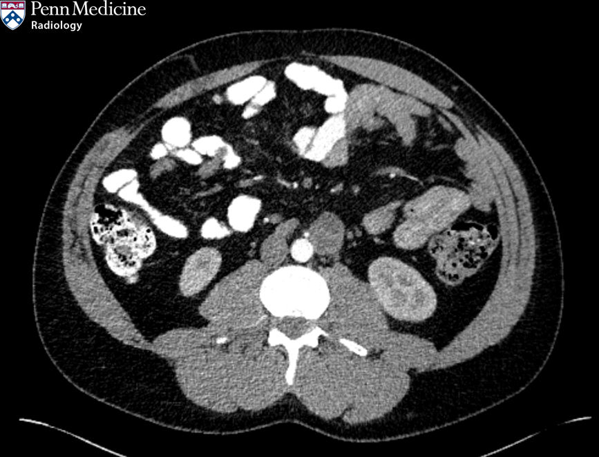 32-year-old man with erythrocytosis, hypertension, anxiety