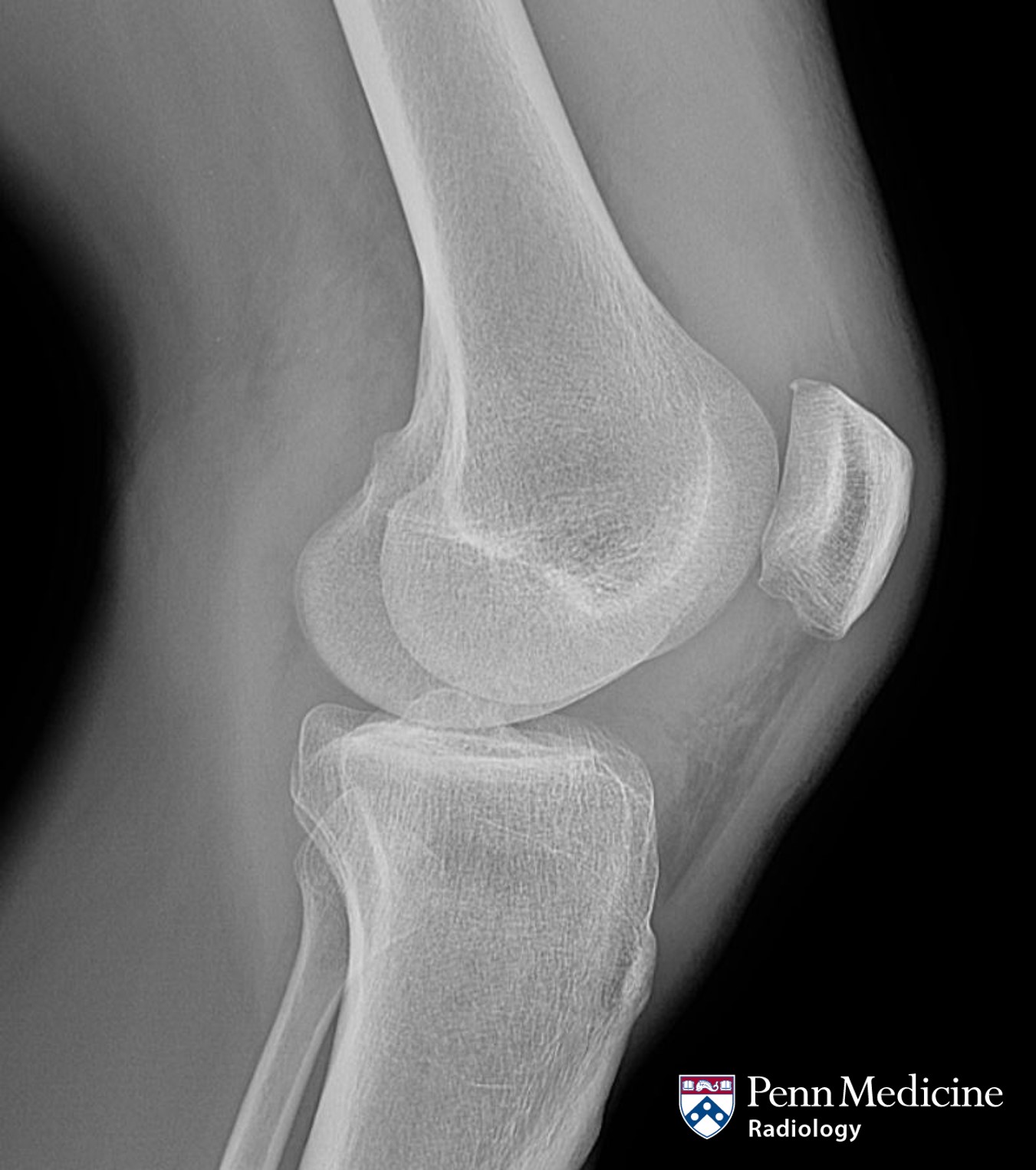 26-year-old man with acute knee pain