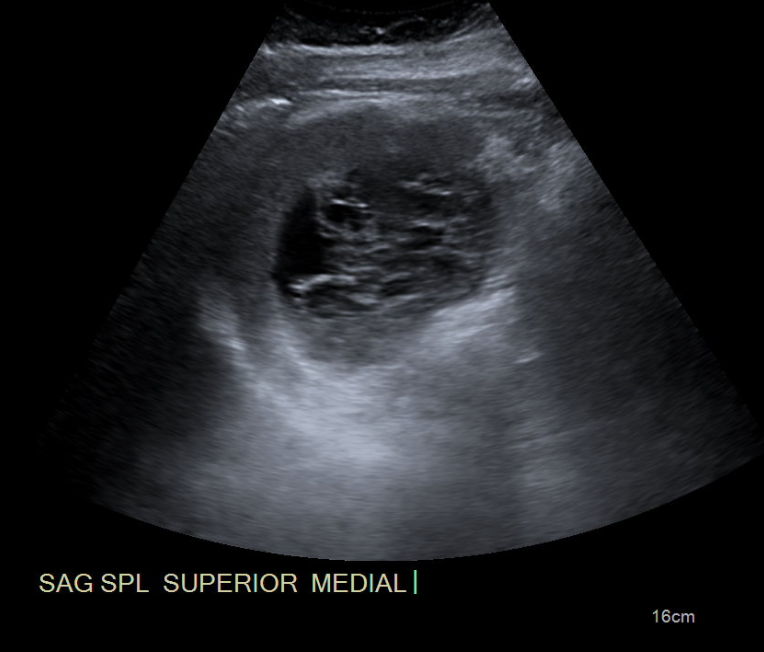 47-year-old man with abdominal discomfort