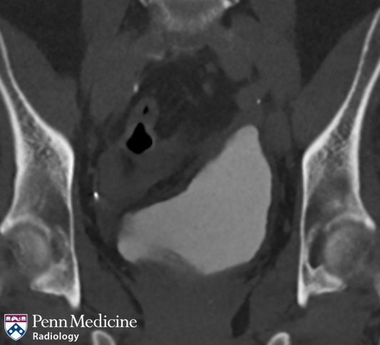 58-year-old woman with history of hematuria