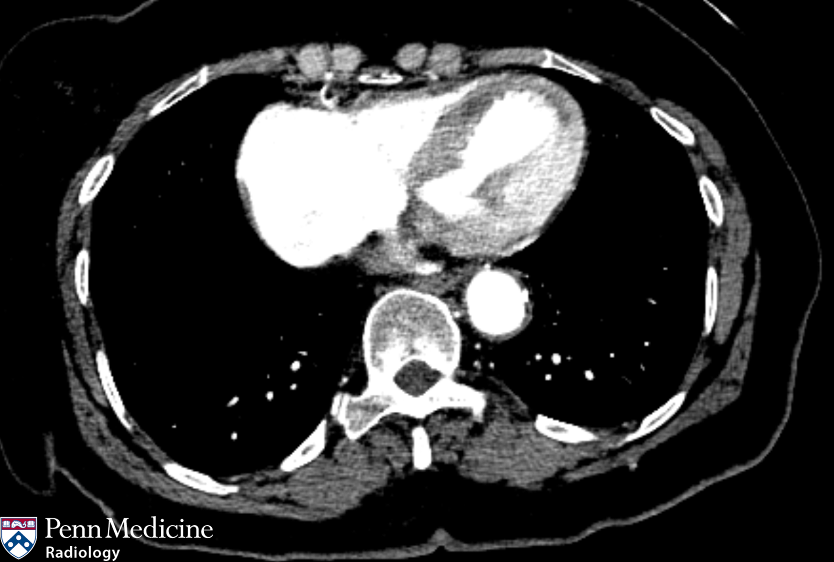 73-year-old woman with longstanding chest pain, shortness of breath