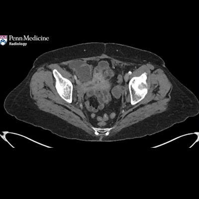49-year-old woman with dysuria, pneumaturia